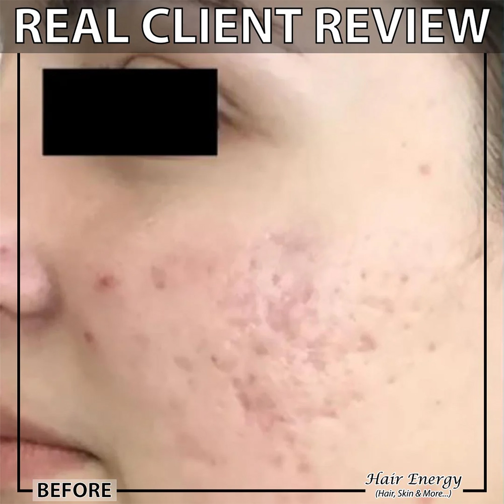 Derma Roller 0.5mm (Black) For Hair Regrowth, Acne Scars, Wrinkles & Skin Rejuvenation - Image 9