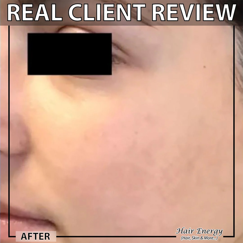 Derma Roller 0.5mm (Black) For Hair Regrowth, Acne Scars, Wrinkles & Skin Rejuvenation - Image 10